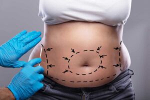 How Do I Prepare for a Tummy Tuck?